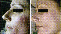 Treament and Pictures by Dr.Philippa McCaffrey MD Methods:1.5mm roller / After 12weeks (50%이상 현저히 개선) - img12_08-2
